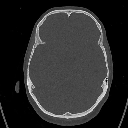 Cerebral venous infarction with hemorrhage (Radiopaedia 65343-74381 Axial bone window 55).jpg