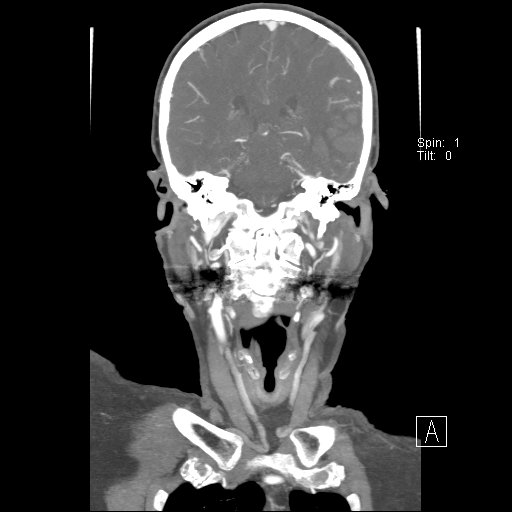 Cerebral venous infarction with hemorrhage (Radiopaedia 65343-74396 B 174).jpg