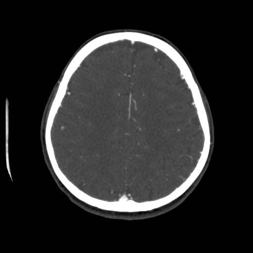 Cerebral venous sinus thrombosis (Radiopaedia 40619-43227 A 165).jpg