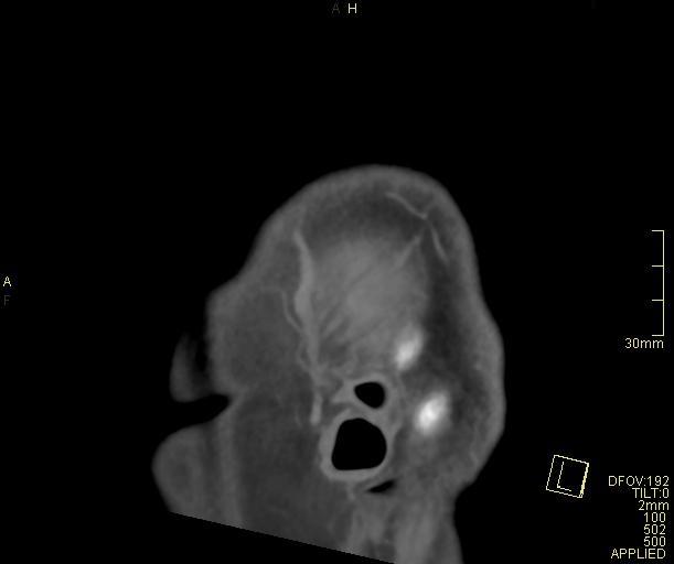 Cerebral venous sinus thrombosis (Radiopaedia 91329-108965 Sagittal venogram 73).jpg