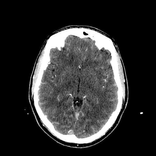 File:Cerebral venous thrombosis (CVT) (Radiopaedia 77524-89685 Axial with contrast 18).jpg