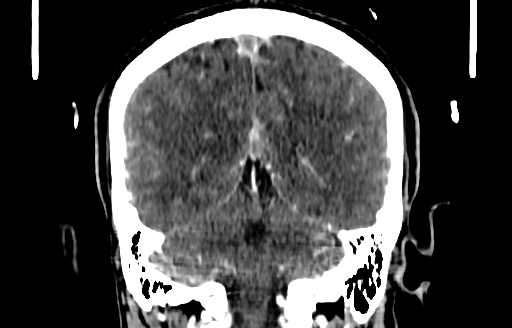 Cerebral venous thrombosis (CVT) (Radiopaedia 77524-89685 C 44).jpg