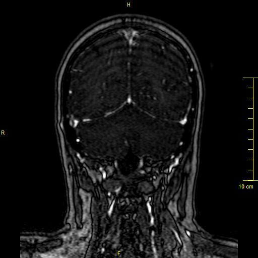Cerebral venous thrombosis (Radiopaedia 23288-23351 MRV 129).JPG