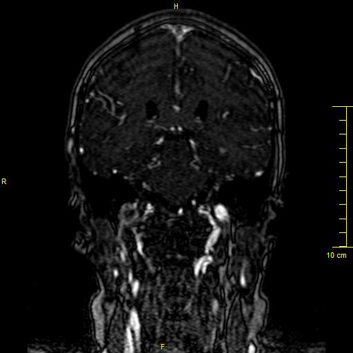 Cerebral venous thrombosis (Radiopaedia 23288-23351 MRV 96).JPG