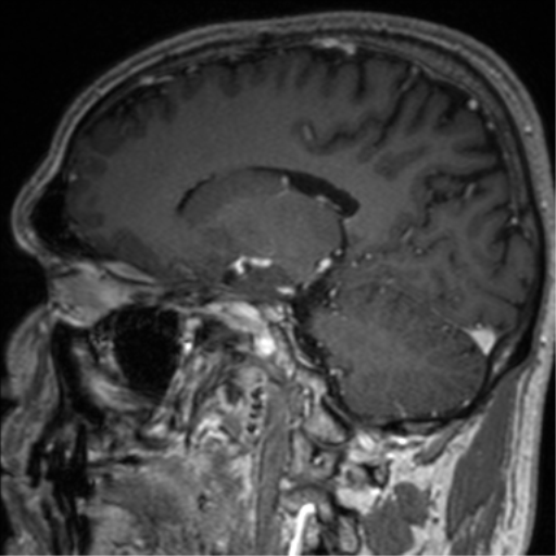 Cerebral venous thrombosis (Radiopaedia 38392-40469 Sagittal T1 C+ 53).png