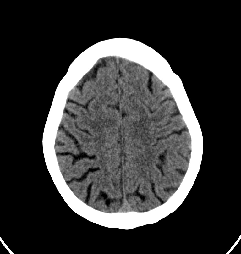 Cerebral venous thrombosis - CT only (Radiopaedia 41031-43778 Axial non-contrast 16).jpg
