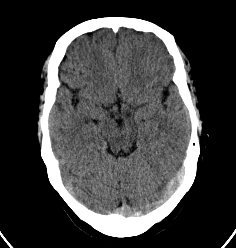 Cerebral venous thrombosis - CT only (Radiopaedia 41031-43778 Axial non-contrast 54).jpg