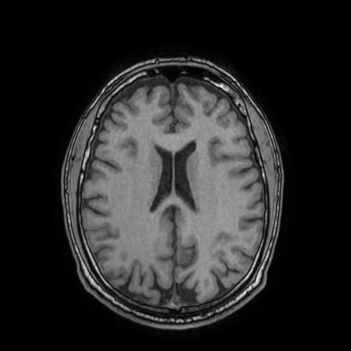 Cerebral venous thrombosis with secondary intracranial hypertension (Radiopaedia 89842-106957 Axial T1 111).jpg