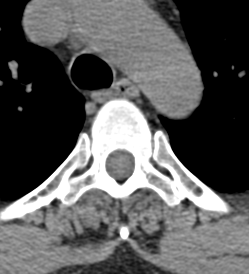 File:Cervical canal stenosis - OPLL and osteophytes (Radiopaedia 47329-51910 Axial non-contrast 74).png