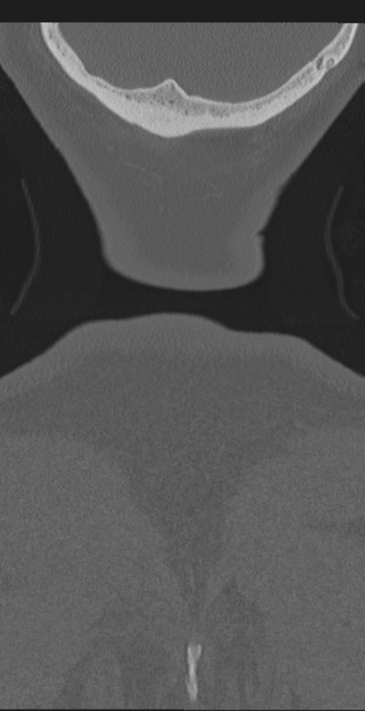 Cervical canal stenosis due to ossification of the posterior longitudinal ligament (Radiopaedia 47260-51823 Coronal bone window 79).png