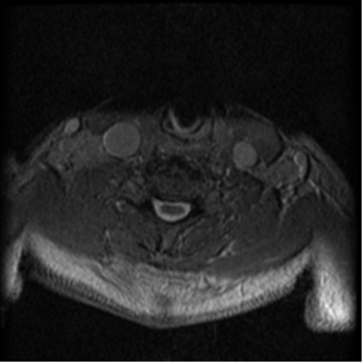 Cervical canal stenosis with cord compression (Radiopaedia 34114-35374 Axial Gradient Echo 29).png