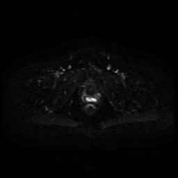 File:Cervical carcinoma (Radiopaedia 85405-101028 Axial DWI 4).jpg