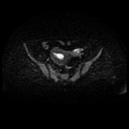 Cervical carcinoma (Radiopaedia 88010-104555 Axial DWI 36).jpg