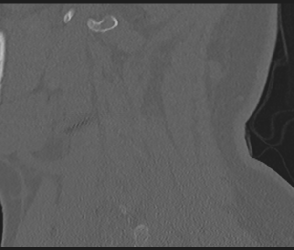 Cervical disc replacement (Radiopaedia 44025-47541 Sagittal bone window 19).png