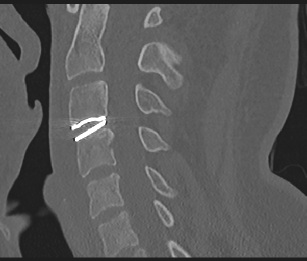 Cervical disc replacement (Radiopaedia 44025-47541 Sagittal bone window 44).png
