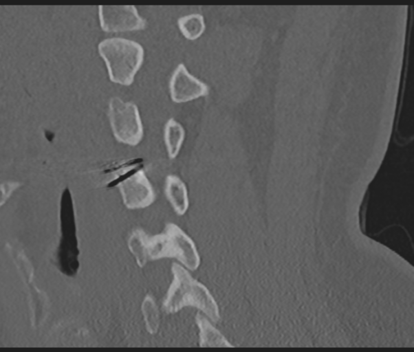Cervical disc replacement (Radiopaedia 44025-47541 Sagittal bone window 51).png