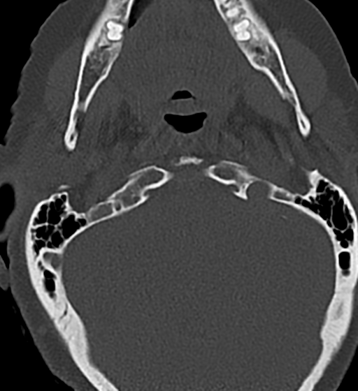 Cervical spine ACDF loosening (Radiopaedia 48998-54070 Axial bone window 9).png