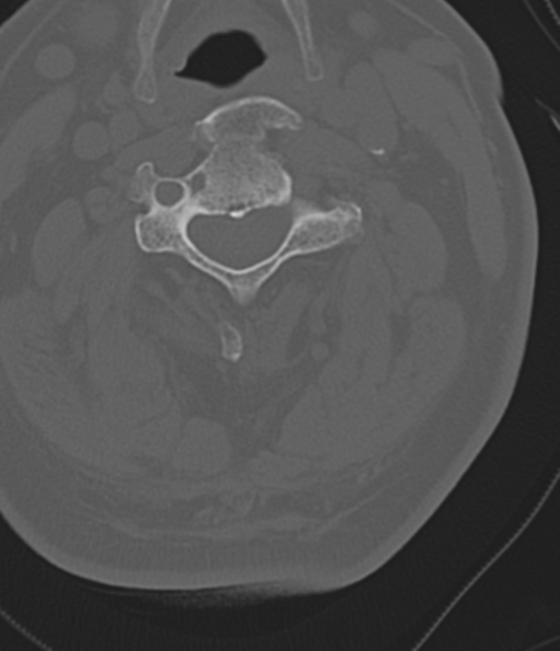 File:Cervical spine fracture in the setting of ankylosis (Radiopaedia 37038-38715 Axial bone window 25).png
