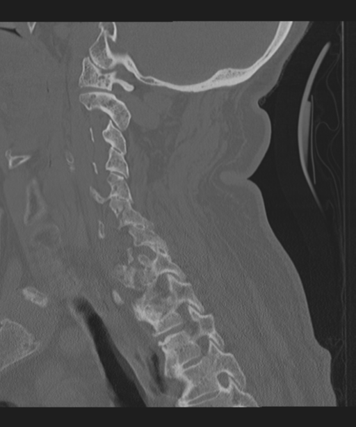 Cervical spine fracture in the setting of ankylosis (Radiopaedia 37038-38715 Sagittal bone window 51).png