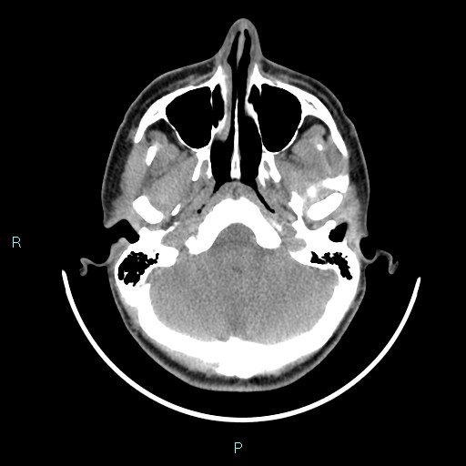 Cervical thymic cyst (Radiopaedia 88632-105335 Axial non-contrast 107).jpg