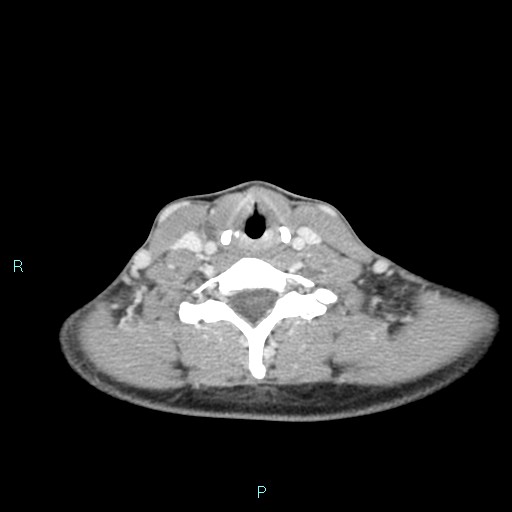 File:Cervical thymic cyst (Radiopaedia 88632-105335 C 46).jpg