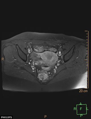 File:Cesarian scar endometriosis (Radiopaedia 68495-78066 Axial T1 C+ fat sat 13).jpg