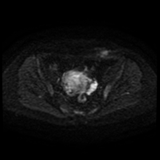 File:Cesarian section scar endometriosis (Radiopaedia 66520-75799 Axial DWI 60).jpg