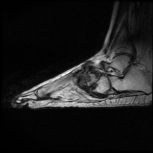 File:Charcot arthropathy (Radiopaedia 55056-61422 Sagittal T2 12).jpg