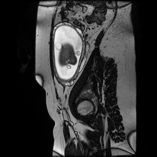 Chiari II malformation - fetal MRI (Radiopaedia 68099-77581 Sagittal Fiesta 10).jpg