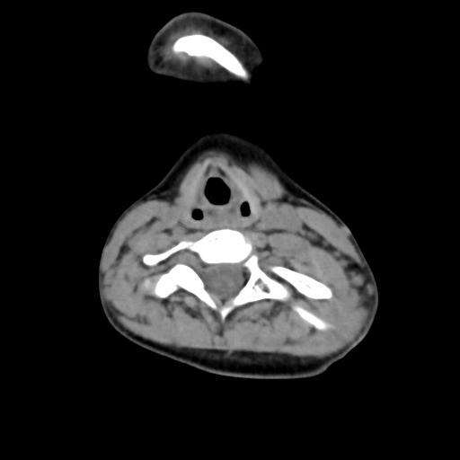 Chiari I with syrinx and skull base anomalies (Radiopaedia 89444-106412 Axial non-contrast 100).jpg
