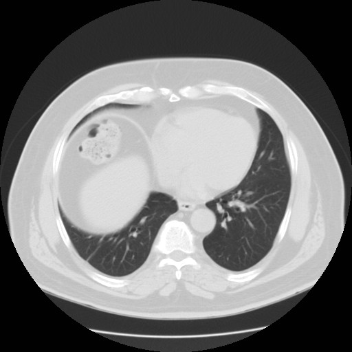File:Chilaiditi’s syndrome (Radiopaedia 27550-27756 Axial lung window 9).jpg