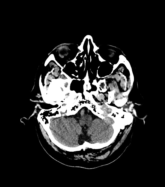 Cholangiocarcinoma with cerebral metastases (Radiopaedia 83519-98628 Axial non-contrast 16).jpg