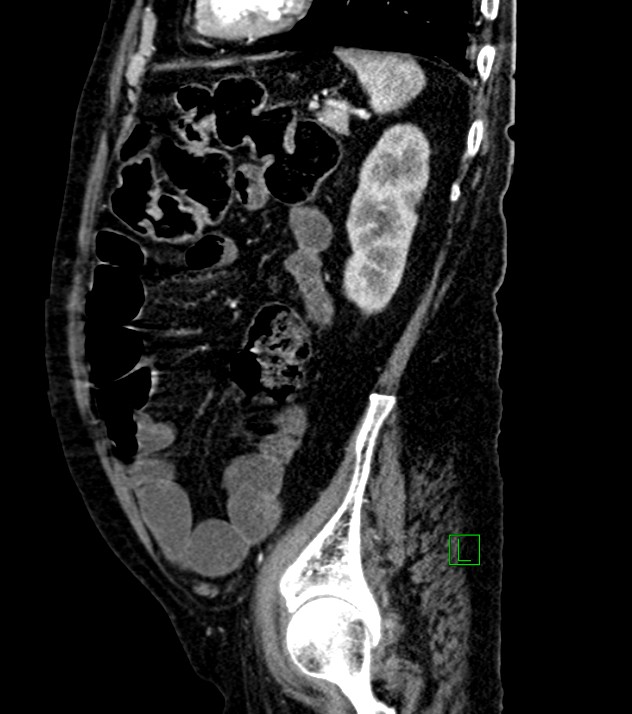 Cholangiocarcinoma with cerebral metastases (Radiopaedia 83519-98629 F 35).jpg