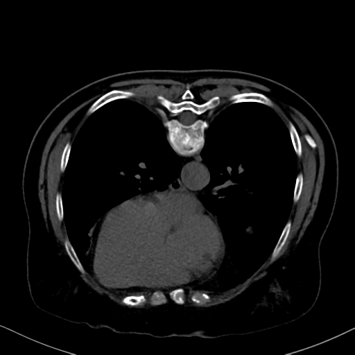File:Cholecystitis - obstructive choledocholitiasis (CT intravenous cholangiography) (Radiopaedia 43966-47479 Axial 69).png