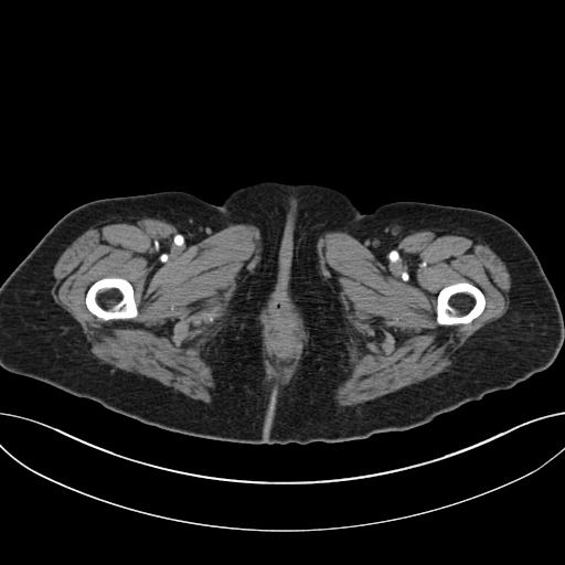 Cholecystoduodenal fistula due to calculous cholecystitis with gallstone migration (Radiopaedia 86875-103077 A 83).jpg