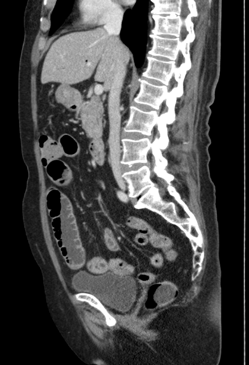 Cholecystoduodenal fistula due to calculous cholecystitis with gallstone migration (Radiopaedia 86875-103077 F 33).jpg