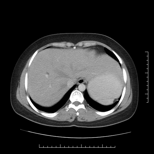 File:Choledochal cyst with chronic calcific pancreatitis (Radiopaedia 18245-18061 A 2).png