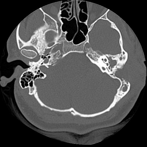Cholesteatoma (Radiopaedia 84960-100474 Axial bone window 47).jpg