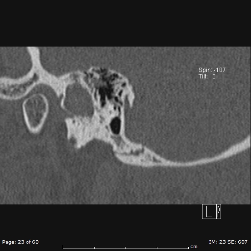 File:Cholesteatoma - external auditory canal (Radiopaedia 88452-105096 Sagittal bone window 23).jpg