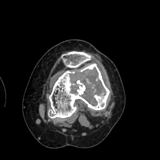 Chondrosarcoma - femur (Radiopaedia 64187-72954 Axial non-contrast 45).jpg