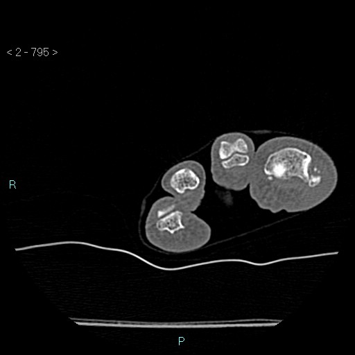 Chondrosarcoma - phalanx (Radiopaedia 69047-78812 Axial bone window 49).jpg
