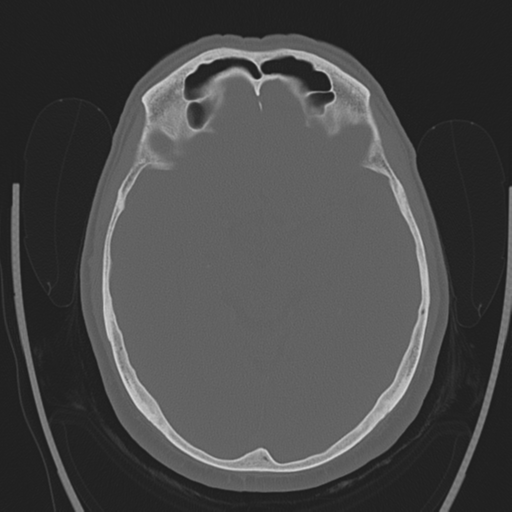 File:Chondrosarcoma of skull base- grade II (Radiopaedia 40948-43653 Axial bone window 20).png