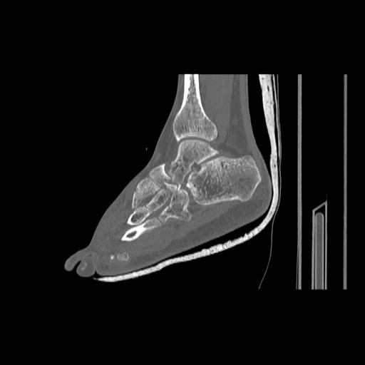 File:Chopart fracture (Radiopaedia 12386-12650 Sagittal bone window 14).jpg