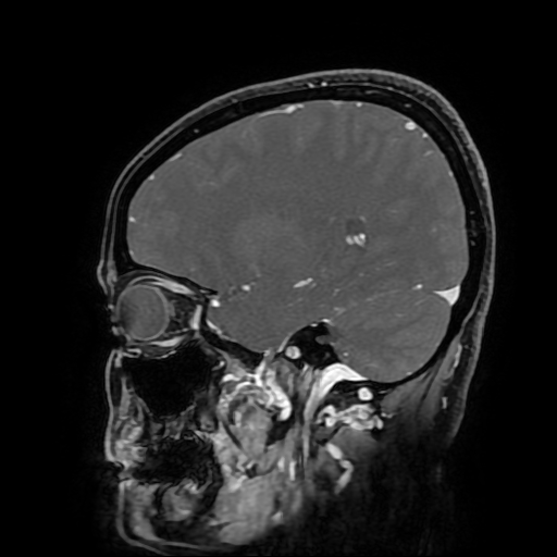 Chordoid glioma of third ventricle (Radiopaedia 91612-109340 F 74).jpg