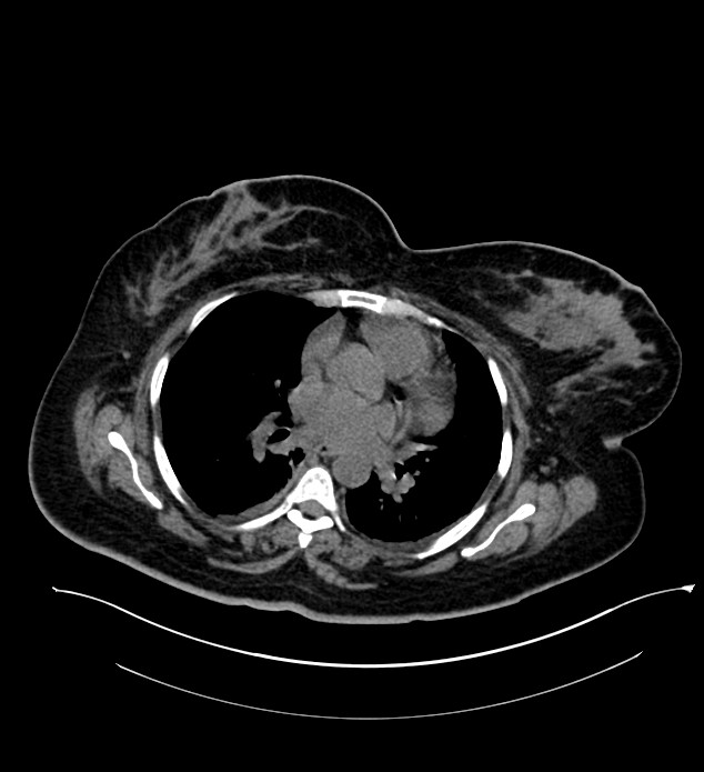 Chromophobe renal cell carcinoma (Radiopaedia 84239-99519 Axial non-contrast 6).jpg
