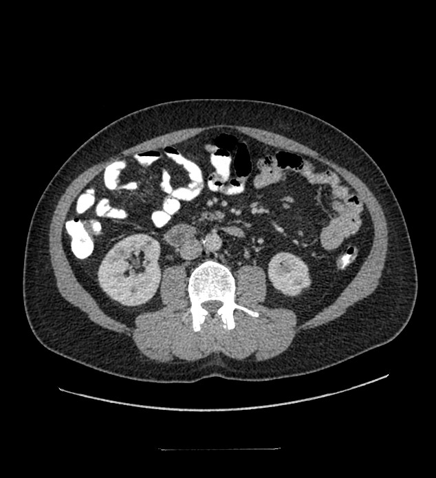 Chromophobe renal cell carcinoma (Radiopaedia 84337-99644 C 65).jpg