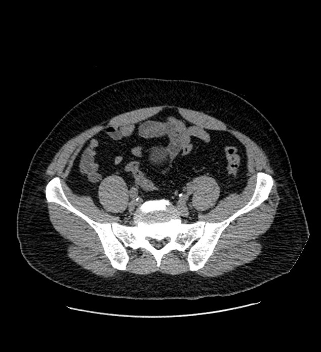 Chromophobe renal cell carcinoma (Radiopaedia 84337-99693 Axial non-contrast 117).jpg