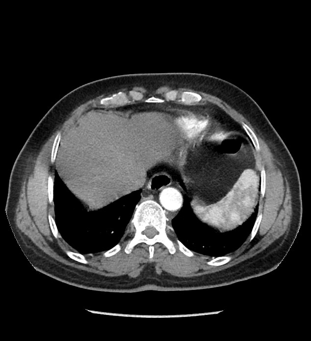 Chromophobe renal cell carcinoma (Radiopaedia 86879-103083 B 18).jpg