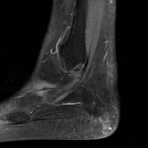 File:Chronic Achilles tendon rupture (Radiopaedia 15262-15100 C 1).jpg