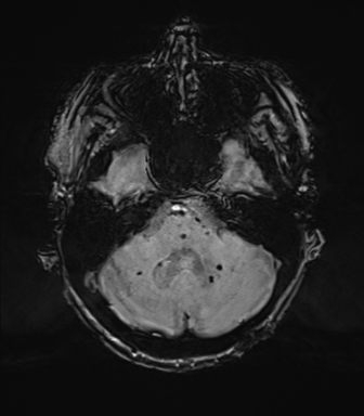 Chronic hypertensive encephalopathy (Radiopaedia 72844-83495 Axial SWI 20).png
